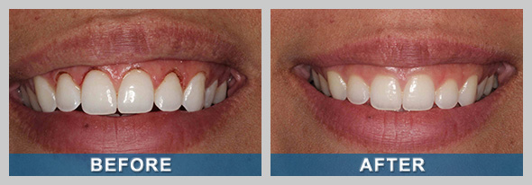 Laser Treatment Before and After