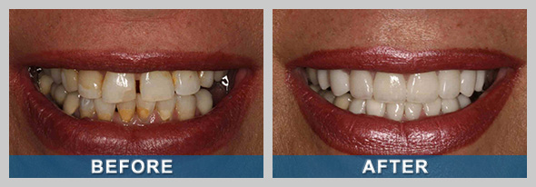 Before and after photo of a Sparks NV patient's dental veneers.