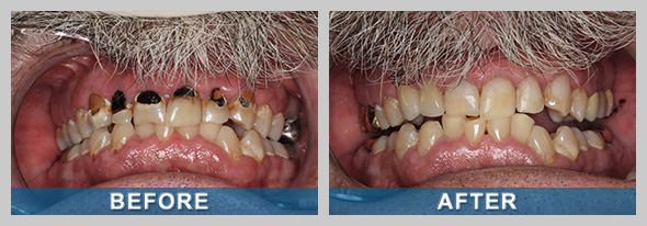 Restorative Dentistry Before and After Treatment