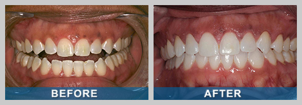 Before and after photo of a Sparks NV patient after teeth whitening in Reno.